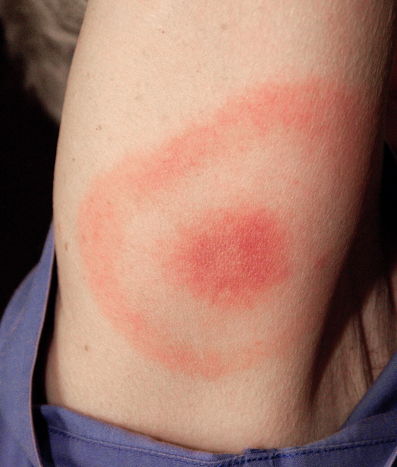 Erythema Migrans - rode ring op been